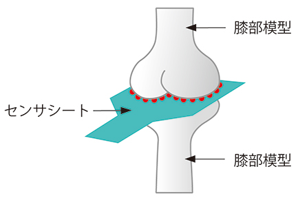 関節置換術、TKA